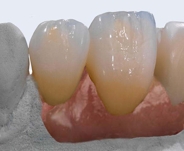 mplants implant dentures crowns emax monolithic zirconia crowns veneers occlusal splints talon dental australia high quality crowns
