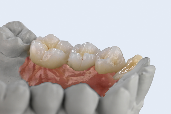 implants, implant dentures, crowns, emax monolithic, zirconia crowns, veneers, occlusal splints